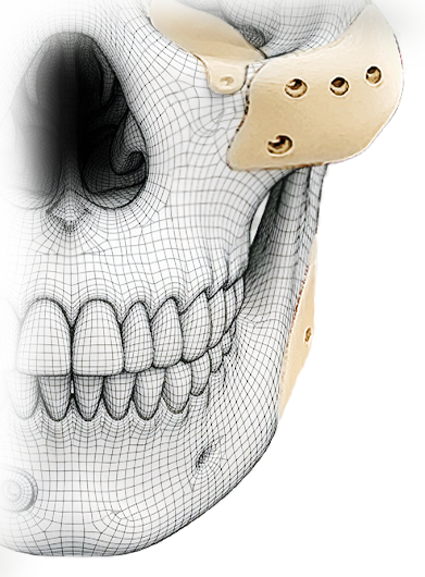 Cranial implant bottom right