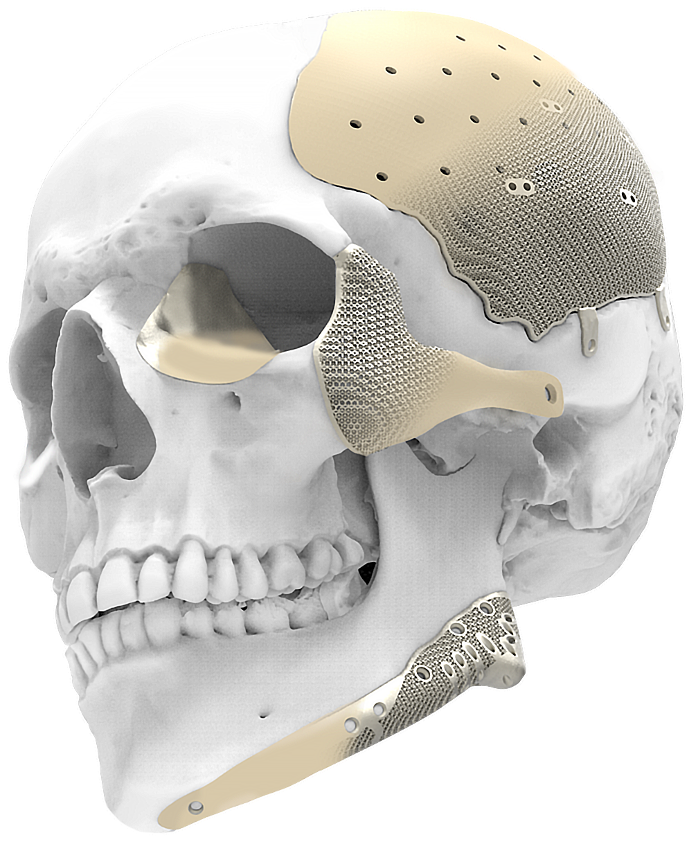 Patient-specific implant montage